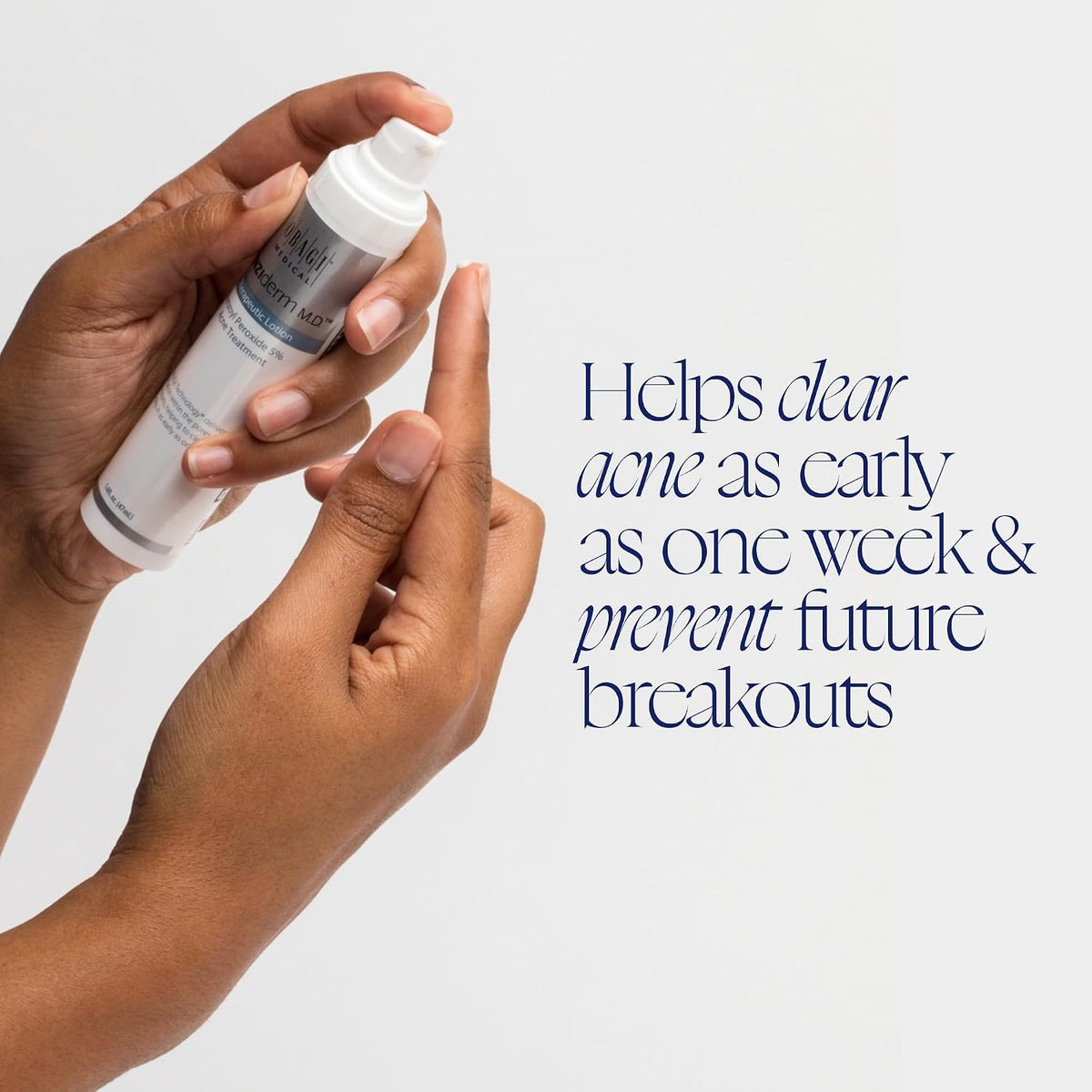 Obagi CLENZIderm MD Therapeutic Lotion 5% BPO Acne Treatment